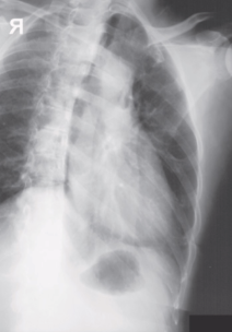 <p><span style="background-color: transparent;">attempt at AP/PA ribs</span></p>