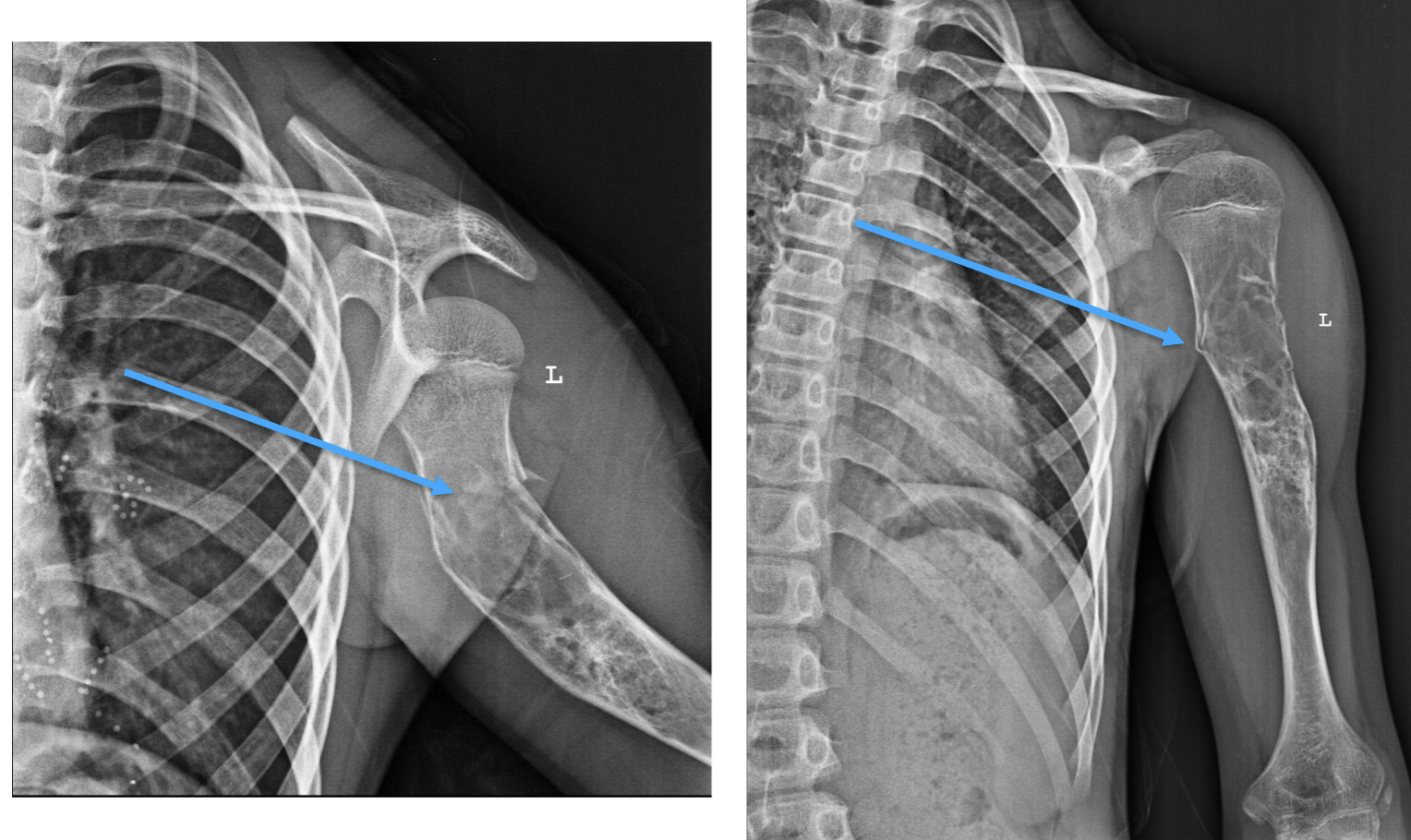 <p>What bone tumour is this, what bone is it in and what can be seen?</p>