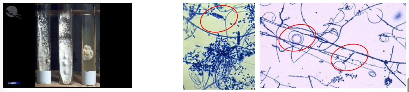 <p>IDEM CHEZ T. mentagrophytes, différence par le<span style="color: rgb(0, 249, 255);"> type de lésion</span></p><p>Aspect Macroscopique :</p><ul><li><p>Recto = Blanc, aspect poudreux</p></li><li><p>Verso = Jaune brun</p></li></ul><p></p><p>Aspect microscopique:</p><ul><li><p>Macroconidies en massue, paroi mince et lisse</p></li><li><p>Microconidies piriforme en grappe sur des filaments à angle droit</p></li><li><p>Filaments mycéliens septés à angles droits + <span style="color: rgb(242, 169, 0);"><strong><em><u>Vrilles</u></em></strong></span></p></li></ul><p></p>