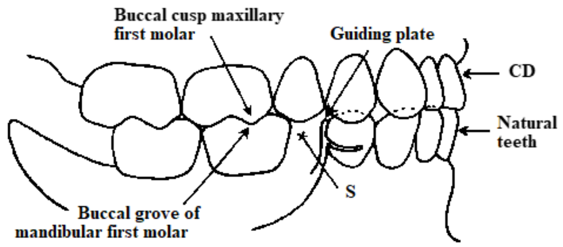 <p>Sometimes, the space “S” is SO narrow that you may have to grind away 50% of a plastic premolar to allow the tooth to fit. How are the teeth set?</p>
