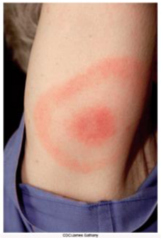 <p><strong><mark data-color="blue" style="background-color: blue; color: inherit;">Bacterial</mark></strong><mark data-color="blue" style="background-color: blue; color: inherit;"> skin disease</mark></p><p>» recognized mid 1970’s in Lyme, Connecticut by <strong>Dr. Willy Burgdorfer</strong></p><p><strong><mark data-color="purple" style="background-color: purple; color: inherit;">[__]</mark></strong>: <mark data-color="yellow" style="background-color: yellow; color: inherit;">progresses through </mark><mark data-color="purple" style="background-color: purple; color: inherit;">3 stages</mark></p><p><strong><mark data-color="purple" style="background-color: purple; color: inherit;">days-weeks » early localized infection</mark></strong></p><p><mark data-color="yellow" style="background-color: yellow; color: inherit;">→ </mark><strong><mark data-color="yellow" style="background-color: yellow; color: inherit;">Erythra migrans</mark></strong><mark data-color="yellow" style="background-color: yellow; color: inherit;">: expanding, “bulls eye” rash as bacteria migrates outward</mark></p><p><mark data-color="yellow" style="background-color: yellow; color: inherit;">→ flu-like symptoms</mark>, such as chills, headaches, and muscle pains</p><p><strong><mark data-color="purple" style="background-color: purple; color: inherit;">2-8 weeks » early disseminated infection</mark></strong></p><p>→ enters bloodstream and affects other parts of the body</p><ul><li><p><mark data-color="yellow" style="background-color: yellow; color: inherit;"><sub>in the heart, impairs electric conduction</sub></mark></p></li><li><p><mark data-color="yellow" style="background-color: yellow; color: inherit;"><sub>in nervous system, leads to paralysis and impaired mental stability</sub></mark></p></li><li><p><mark data-color="yellow" style="background-color: yellow; color: inherit;"><sub>in joints, leads to arthritis</sub></mark></p></li><li><p><mark data-color="yellow" style="background-color: yellow; color: inherit;"><sub>(doesn’t affect the placenta</sub></mark><sub> as it isn’t able to cross)</sub></p></li></ul><p><strong><mark data-color="purple" style="background-color: purple; color: inherit;">~6 months after skin rash</mark></strong></p><p><mark data-color="yellow" style="background-color: yellow; color: inherit;">→ severe headache, neck stiffness, joint pain, swelling</mark></p><p>→ chronic nervous system impairments</p><ul><li><p><mark data-color="yellow" style="background-color: yellow; color: inherit;"><sub>facial palsy, swollen knee</sub></mark></p></li><li><p><mark data-color="yellow" style="background-color: yellow; color: inherit;"><sub>inflammation of brain and spinal cord</sub></mark></p></li><li><p><mark data-color="yellow" style="background-color: yellow; color: inherit;"><sub>nerve pain, numbness or tingling in the hands or feet</sub></mark></p></li><li><p><mark data-color="yellow" style="background-color: yellow; color: inherit;"><sub>problems with short-term memory</sub></mark></p></li></ul><p></p><p><u><mark data-color="blue" style="background-color: blue; color: inherit;">Spread</mark></u>: <mark data-color="purple" style="background-color: purple; color: inherit;">bite of infected deer tick</mark></p><p><u><mark data-color="blue" style="background-color: blue; color: inherit;">Prevention</mark>:</u> avoid tick-infested areas</p><p><sub>» use protective clothing; use tick repellents</sub></p><p><sub>» carefully inspect body and remove attached ticks carefully</sub></p><p><u><mark data-color="blue" style="background-color: blue; color: inherit;">Treatment</mark></u>: antibiotics effective in early stages</p>