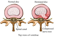 <p>Herniated "slipped" disc: A tear in the annulus fibrosus that allows the protrusion of the nucleus pulposus --> presses on the spinal nerve causing pain. It can go away with time or with surgical intervention</p>