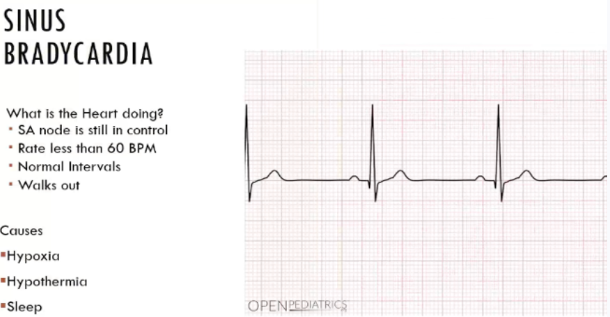 <p>sinus bradycardia</p>