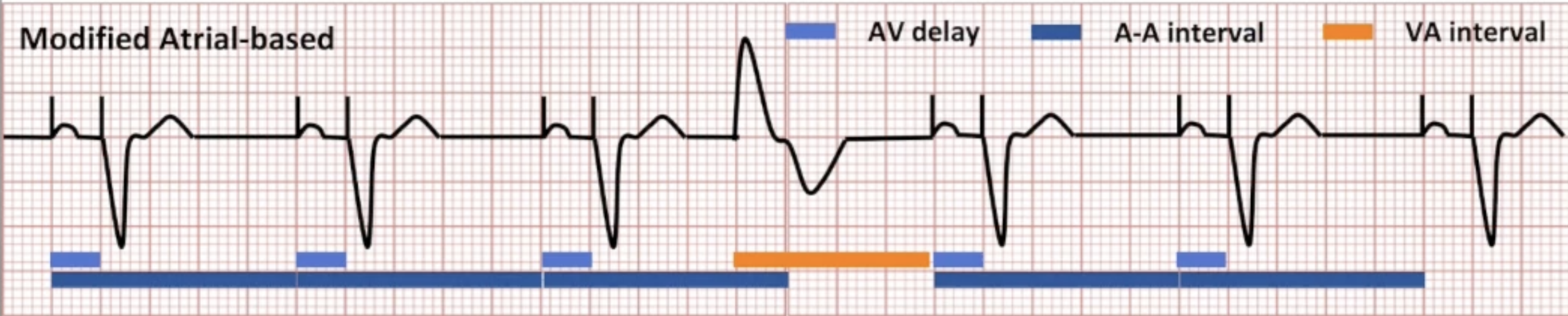 <ul><li><p>Normal beats: operates like atrial-based</p></li><li><p>PVCs: triggers VA interval instead of A-A interval</p></li></ul><p></p>