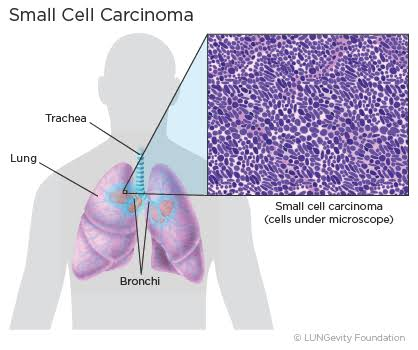 <p>small cell (oat cell) carcinoma </p>