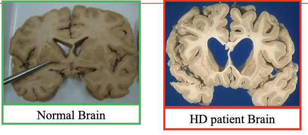 <p>hyperkinetic disorder; progressive, autosomal dominant neurodegenereative disorder</p><ul><li><p>decreased tonic inhibition of thalamus; increased disinhibition of thalamus</p></li><li><p>etiology: inherited; loss of projections to GPe, reduced size of caudate and putamen, loss of MSN in striatum</p></li><li><p>motor symptoms: chorea (brief involuntary movements that flit from one body part to another randomly; can be graceful or dancelike)</p></li><li><p>non-motor symptoms: cognitive disturbances, reduced memory, verbal fluency, judgement, reasoning, poor concentration, difficulty planning, apathy, depression, irritability/temper, withdrawal, anxiety </p></li></ul><p></p>