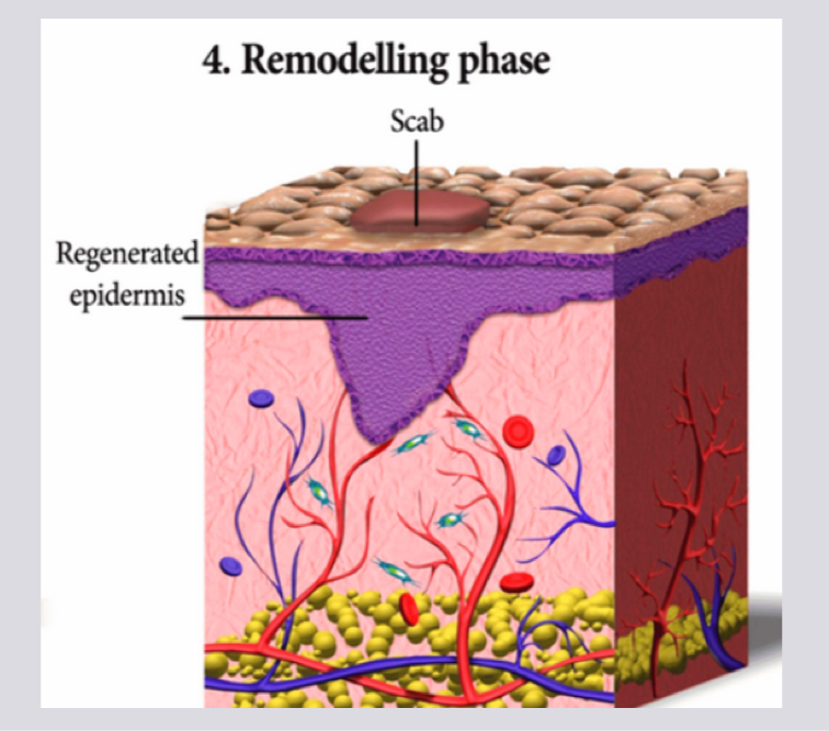 <p>Remodeling phase</p>