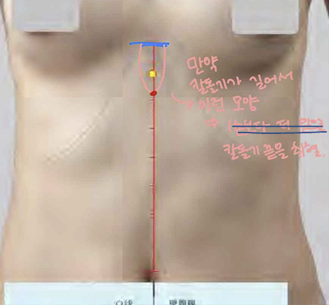 <p>앞정중선 위, 칼몸통결합 아래 1寸</p>