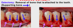 <p>Removal of supporting bone.</p><p>(Explanation: Ostectomy removes bone that supports the tooth, used sparingly to correct defects or achieve desired bone contours, but it risks compromising tooth stability.)</p>