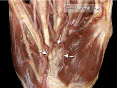 <p>In this view of the palm of the hand, identify the vessel indicated by the arrow.</p>