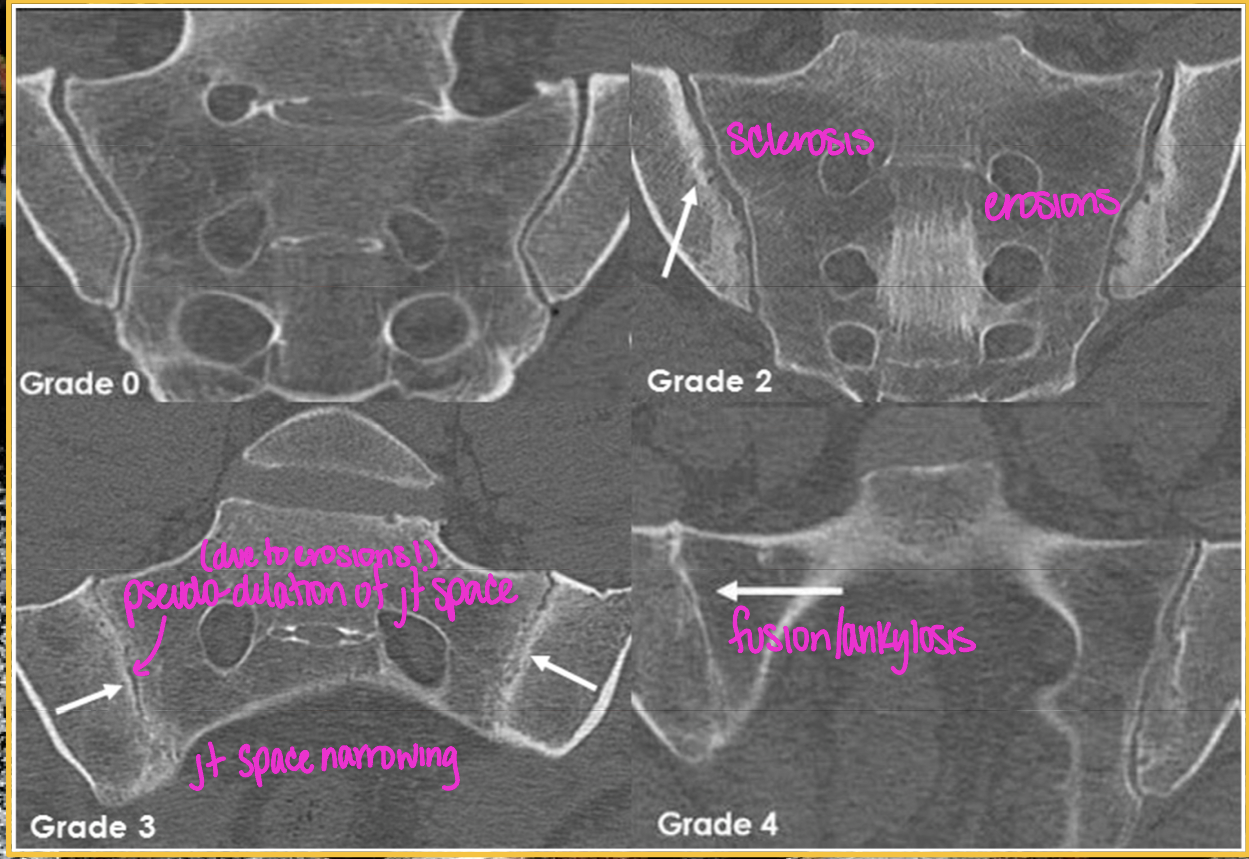 <p>AS Sacroilitis grading </p>