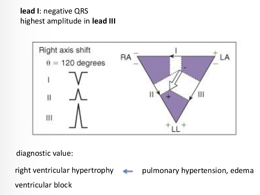<p>Eg the right side is hypertrophied - and so the growth of that ventricle goes in a different direction and the wave direction changes</p>