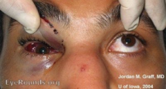 <p>- Occurs when eye muscles become trapped within a fracture (most commonly inferior rectus muscle)... requires urgent response</p><p>- Results in inability to actively move eye within all fields</p><p>warrants surgical exploration if there is no movement, let OMFS know</p>