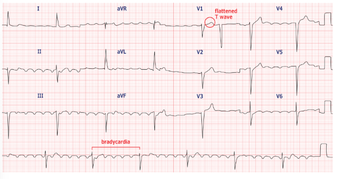 <p>An EKG technician is analyzing the rhythm strip shown here. Using the annotated tracing, the technician counts the small boxes between consecutive R waves and applies the 1500 method to calculate the heart rate. Which of the following findings should be recorded?</p>