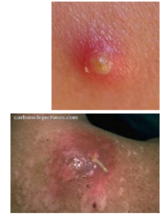 <p><strong><mark data-color="blue" style="background-color: blue; color: inherit;">Bacterial</mark></strong><mark data-color="blue" style="background-color: blue; color: inherit;"> skin disease</mark></p><p><strong><mark data-color="purple" style="background-color: purple; color: inherit;">[__] infections</mark></strong>: <mark data-color="yellow" style="background-color: yellow; color: inherit;">generally mild disease caused by infection of the opening of the hair follicle</mark></p><p><mark data-color="blue" style="background-color: blue; color: inherit;">» </mark><strong><mark data-color="blue" style="background-color: blue; color: inherit;">Folliculitis</mark></strong>: <mark data-color="yellow" style="background-color: yellow; color: inherit;">small area of infection where there is inflammation, red bumps</mark> (pimples)</p><p><mark data-color="blue" style="background-color: blue; color: inherit;">» </mark><strong><mark data-color="blue" style="background-color: blue; color: inherit;">Furuncle</mark></strong> → <mark data-color="yellow" style="background-color: yellow; color: inherit;">infection spreads out to adjacent tissues;</mark></p><p>localized redness, swelling, tenderness, pain, and pus (build up of dead cells)</p><p><mark data-color="blue" style="background-color: blue; color: inherit;">» </mark><strong><mark data-color="blue" style="background-color: blue; color: inherit;">Carbuncle</mark></strong>: <mark data-color="yellow" style="background-color: yellow; color: inherit;">large area of infection; cause for concern</mark></p><p></p><p><u><mark data-color="blue" style="background-color: blue; color: inherit;">Spread</mark></u>: boils shed large numbers of bacteria (<em>S. aureus</em>) that transmits via <strong>hands and fomites</strong> in hair follicle infections</p><p><u><mark data-color="blue" style="background-color: blue; color: inherit;">Treatment</mark></u><mark data-color="blue" style="background-color: blue; color: inherit;">:</mark> <mark data-color="yellow" style="background-color: yellow; color: inherit;">surgical draining, oral antibiotic treatment</mark></p><p>Complicated by antibiotic resistance</p><p><strong><mark data-color="purple" style="background-color: purple; color: inherit;">» MRSA strain</mark></strong> <mark data-color="yellow" style="background-color: yellow; color: inherit;">→ methicillin resistant staphylococcus aureus</mark></p><p><strong><mark data-color="purple" style="background-color: purple; color: inherit;">» VRSA strain</mark></strong> <mark data-color="yellow" style="background-color: yellow; color: inherit;">→ vancomycin resistant staphylococcus aureus</mark></p>