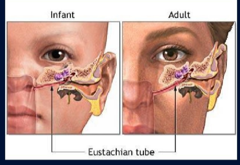 <p>failure to drain mucuous secretions of the middle ear leading to congestion</p>