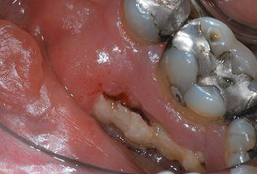 <p>current or previous tx with antiresorptive medication, exposed bone in MF region for longer than 8 wks, no hx of radiation therapy </p>