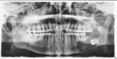 <p>describe the effects of the lesion:</p>