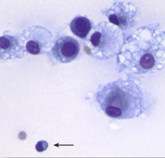 <p>This is synovial fluid from a canine.</p><p>1. what cells are you seeing</p><p>2. inflammatory or noninflammatory?</p><p>3. name a common joint disease associated with this cytology? differentials?</p>
