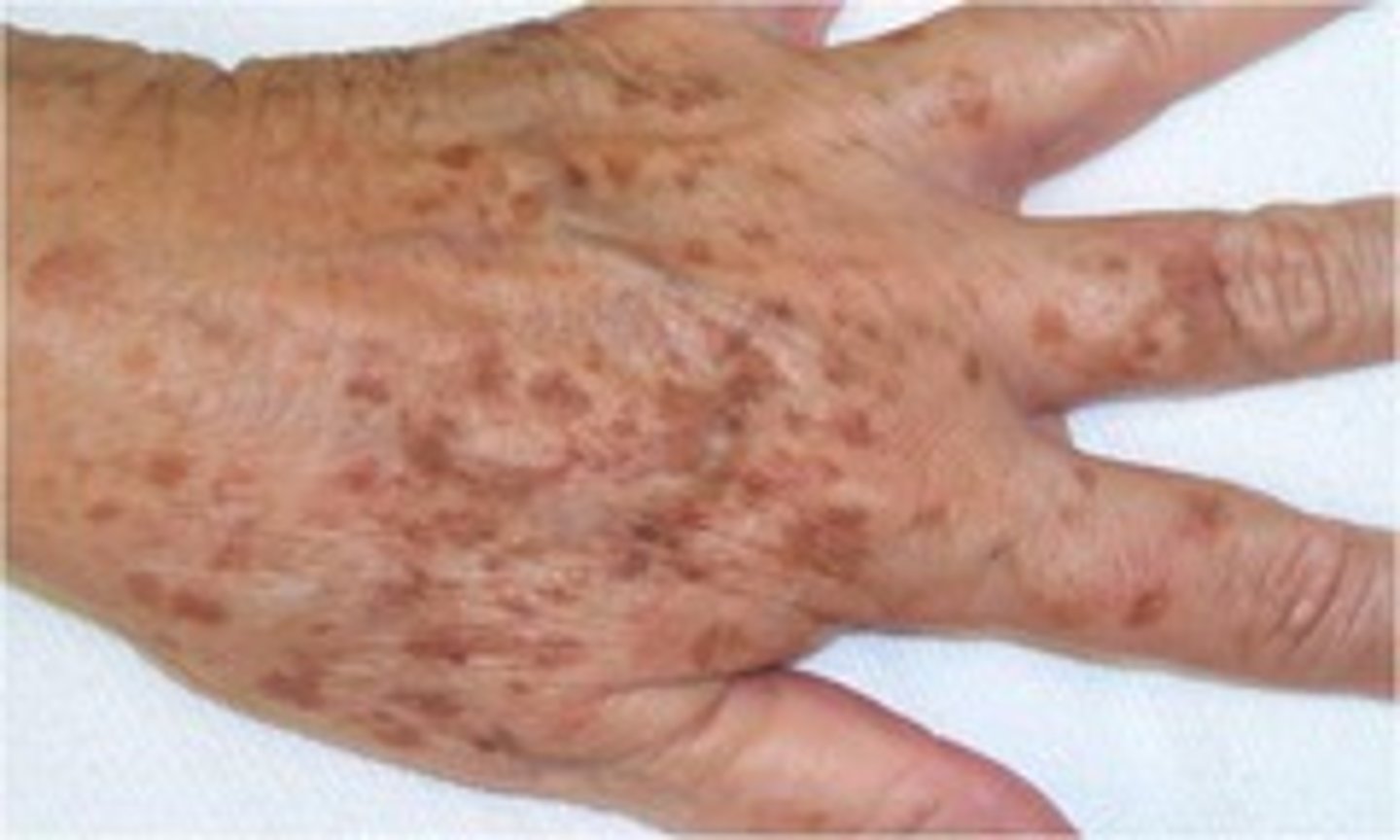 <p>Technical term for freckles</p>