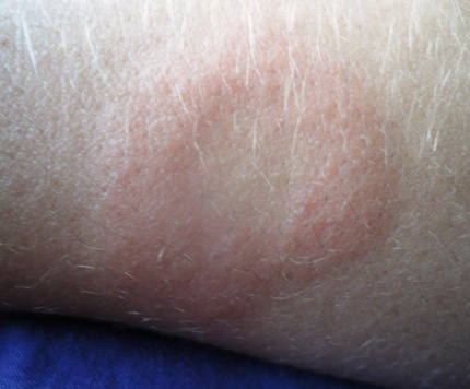 <p>Que enfermedad y bacteria dan este sx característico </p>