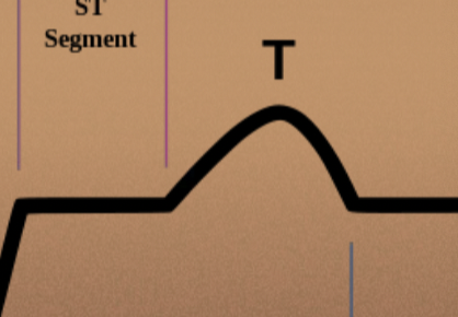 <p>T wave - ventricular repolarization</p>