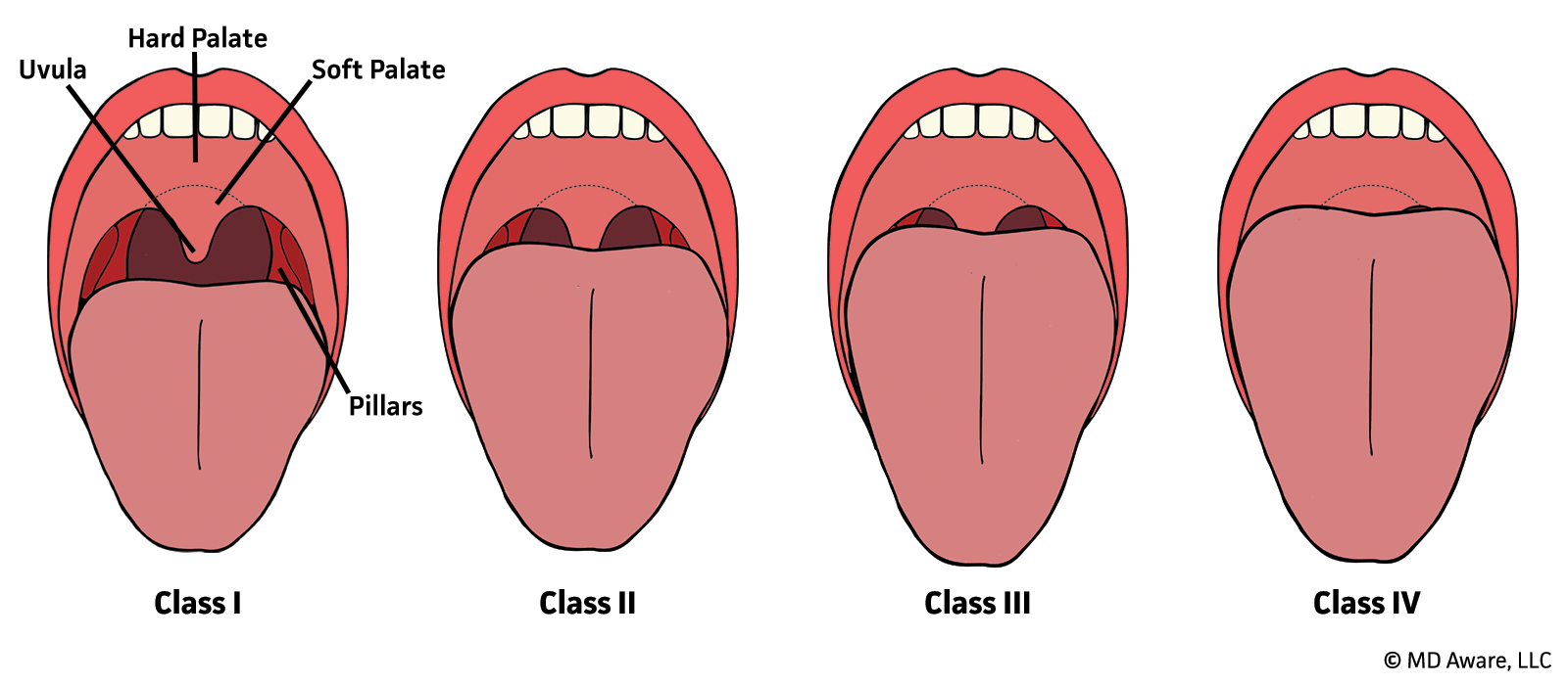 <p>hard palate only</p><p>-very difficult intubation</p>