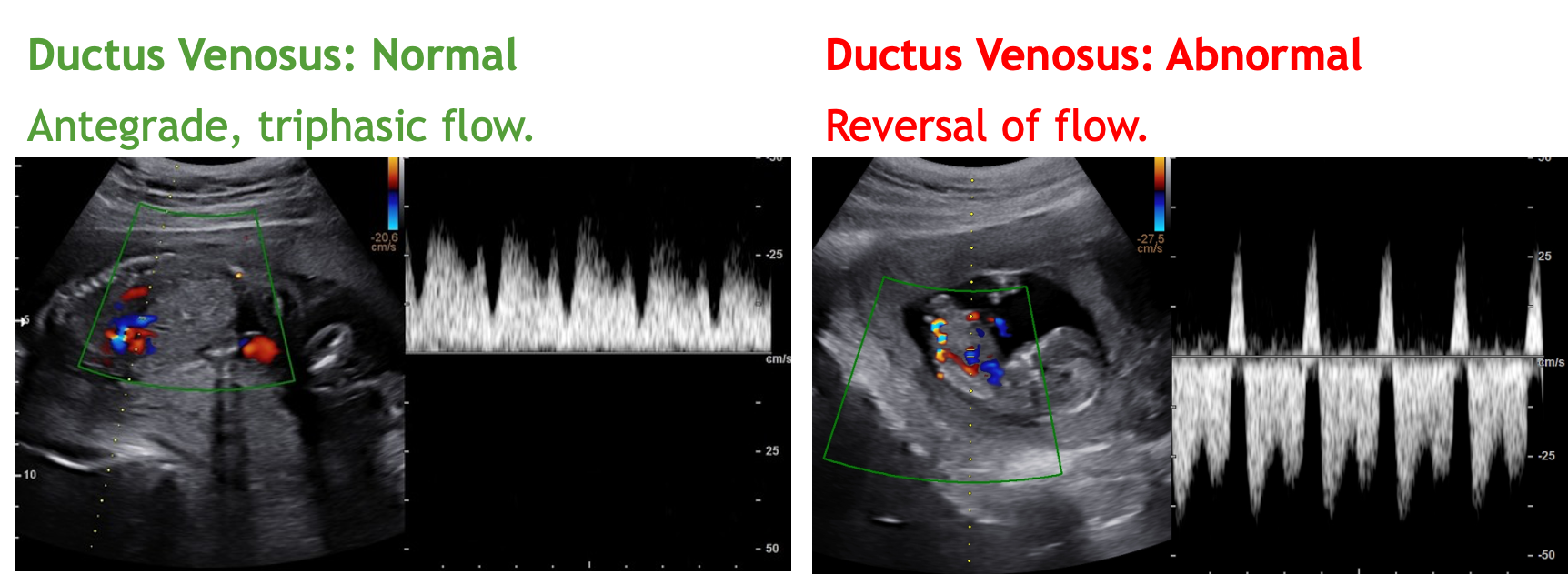 <ul><li><p>connects umbilical vein to the IVC » becomes ligamentum venosum</p></li><li><p>venous structure</p></li><li><p>triphasic, antegrade, continuous flow towards fetal heart</p></li><li><p>abnormal = absent or reversed flow</p></li></ul><p></p>