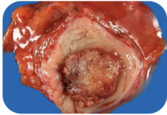 <p>Which type of epithelial tumor is shown in this image?</p>