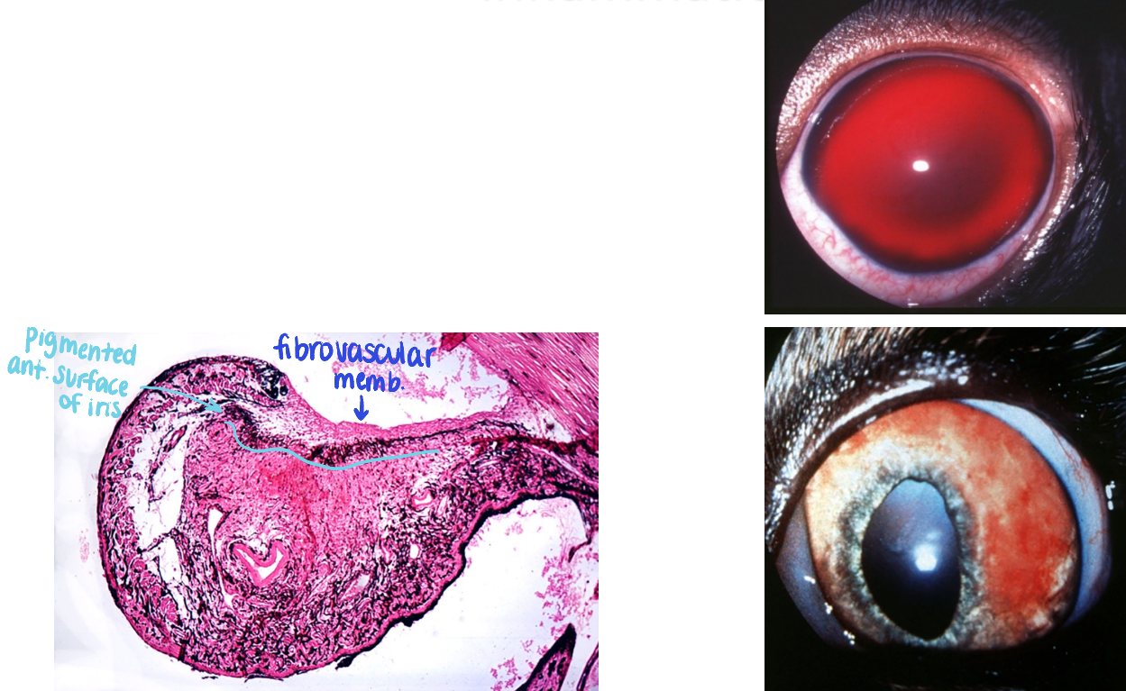 <ul><li><p>angiogenic factors are released into the eye & stimulate iridal blood vessels to proliferate on the anterior surface of the iris</p></li><li><p>fragile vessels may bleed spontaneously; leaky!</p><ul><li><p>hyphema = blood in anterior chamber</p></li></ul></li></ul><p></p>
