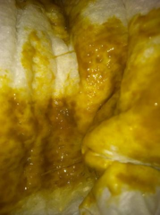 <p>Blood, pus, and mucus.</p>