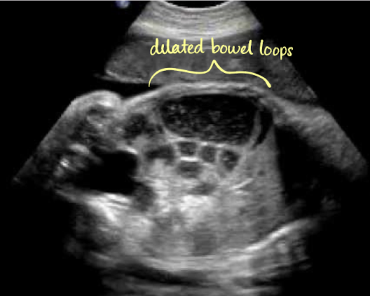 <ul><li><p><span style="color: red;">dilated loops of bowel (cystic dilation)</span></p></li><li><p>persistently full stomach and dilated bowel loops</p></li><li><p><span style="color: red;">absence of peristalsis</span></p><ul><li><p><span style="color: rgb(255, 255, 255);">pay attention to whether or not there’s movement</span></p></li></ul></li><li><p>hydramnios</p></li></ul><p></p>