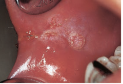 <p>Controversial</p><p>Hyperplastic candidiasis vs. true leukoplakia with superimposed candidiasis</p>