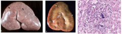 <p>What disorder affecting the renal corpuscles Is being shown with gross lesions including multifocal, randomly distributed, pinpoint white to tan foci in the cortex?</p>