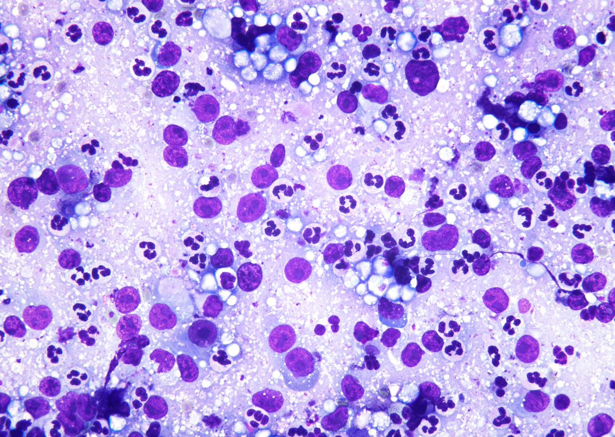 <p>Tumeur du médiastin </p>