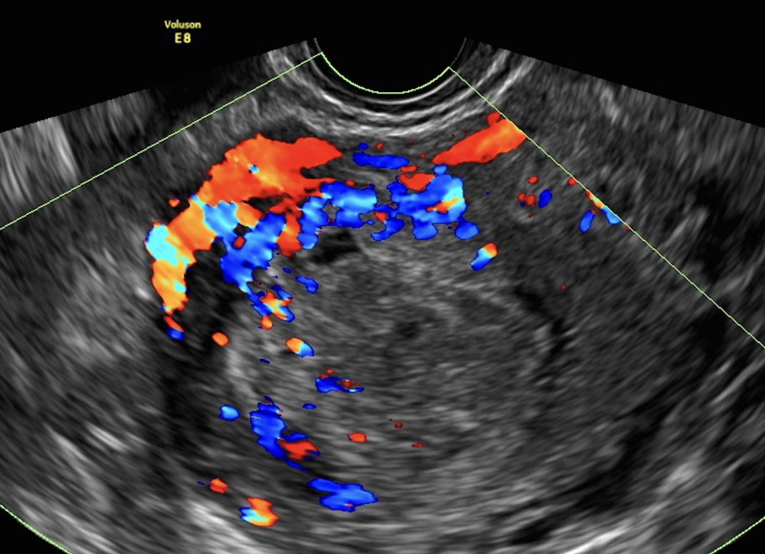 <p>Choriocarcinomas appear as _____________, echogenic, and _______________ masses. </p>
