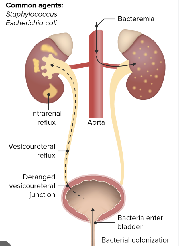 <p>An <strong>upper UTI involving the kidneys; </strong>where bacterial travel up the bladder to your kidneys</p>