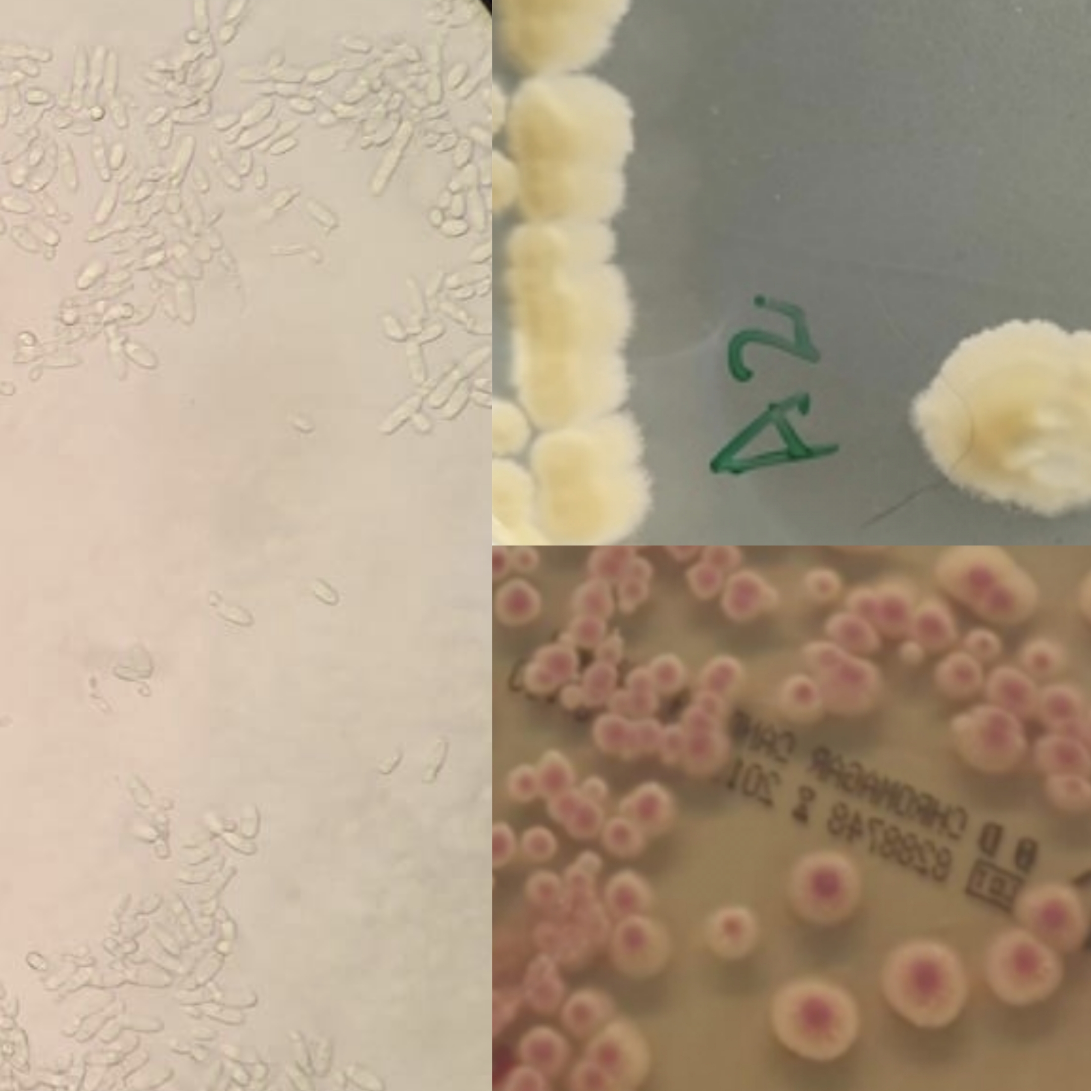 <p>Identifica a levedura pelos resultados nas provas de identificação:</p><p class="has-focus">Prova dos clamidosporos: -</p><p class="has-focus">Prova da filamentaçao: -</p><p class="has-focus">Prova dos ascosporos: -</p><p class="has-focus">Prova da urease: -</p><p class="has-focus">Prova da fenoloxidase: -</p><p class="has-focus">Sensibilidade à cicloheximida: - ( é sensível, n cresce)</p><p class="has-focus">Cor no meio de chromagar Cândida: rosa</p><p class="has-focus">Aspeto macroscopico: bordos franqueados, textura seca e rugosa, com topografia plana</p>