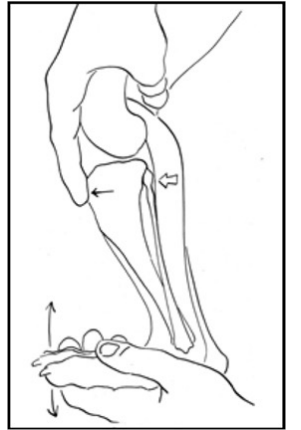 <ul><li><p>Tibial tuberosity and lateral fabella(sesamoid)</p></li><li><p>the right hand holds the stifle in a standing angle while the examiner's left hand flexes the hock to simulate weight-bearing.</p></li><li><p>this maneuver creates cranial tibial thrust by tensing the gastrocnemius muscle. In the CrCL-deficient stifle this cranially-directed shear force palpably shifts the tibia cranial relative to the femu</p></li></ul><p></p>