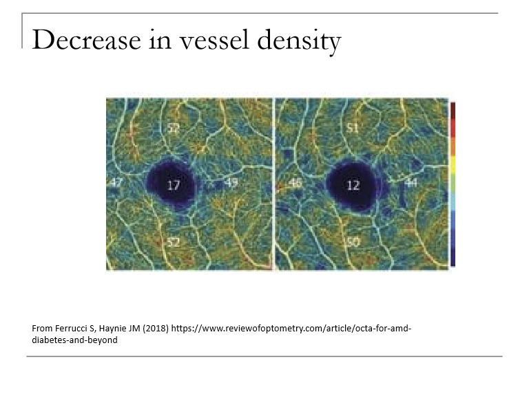 <p>Vessel density decreases with progression.<br>Reflects capillary dropout, non‑perfusion, and ischemia, especially in the deep capillary plexus.</p>