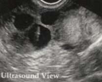 <ul><li><p>ovarian monitoring, needle aspiration of oocytes, incubation of oocytes, fertilization, and transferring the embryos into the uterus</p></li><li><p>aspiration of the oocytes may be done laparoscopically, the transabdominal or transvaginal ultrasound</p></li></ul><p></p>