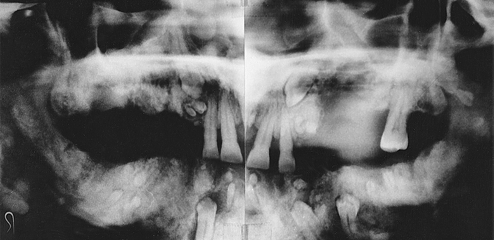 <p>Gardner Syndrome&nbsp;(Familial Colorectal Polyposis) </p>
