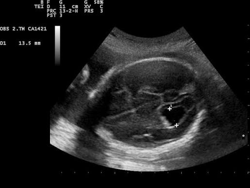 <p>dilation of cerebral ventricles without defining the cause </p>