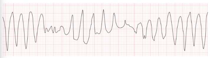 <p>An EKG technician is monitoring a patient when the rhythm strip shown here appears on the screen. Based on the pattern observed in the tracing, which of the following actions is required?</p>