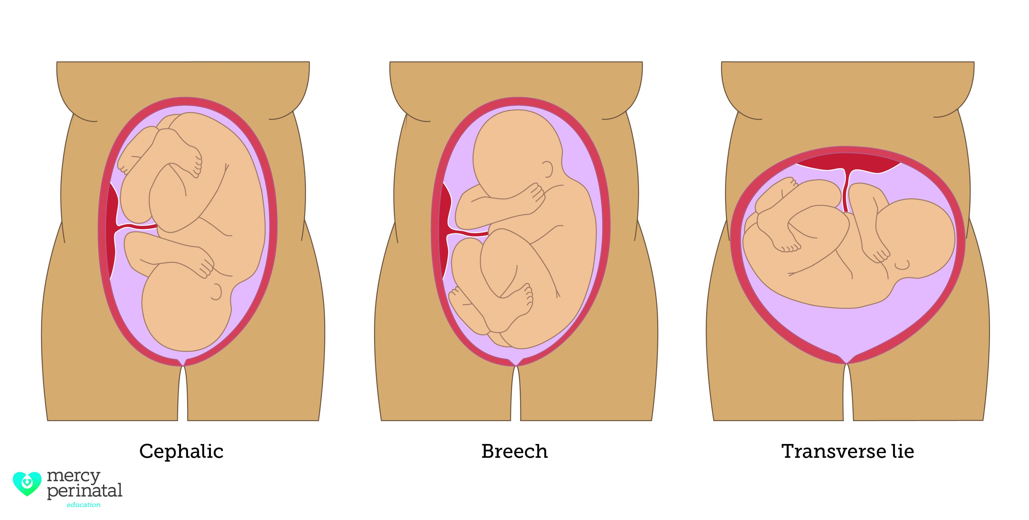<ul><li><p><strong>cephalic/vertex — head</strong></p></li><li><p><strong>breech — buttocks/feet</strong></p></li><li><p><strong>shoulder — shoulder </strong></p></li></ul><p></p>