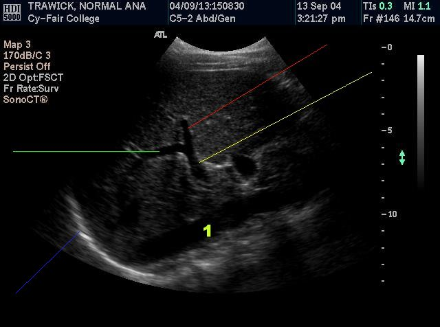 <p><strong>The green line is pointing to the</strong></p><p>Rt hepatic artery</p><p>Rt hepatic vein</p><p>Rt. Portal vein</p><p>Main portal vein</p>