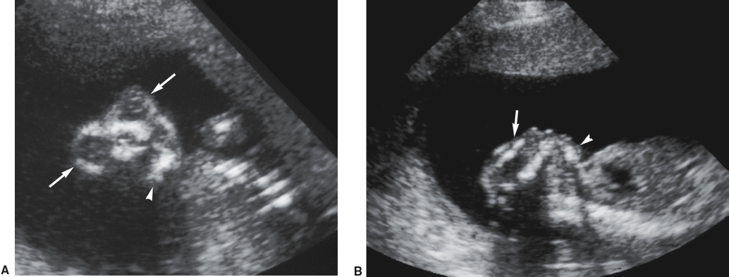 <p>Absent cranial vault</p><p>Some cerebral tissue may be present</p><p>“Froglike” facies or bulging eyes</p><p>Possible fetal movement and active fetal heart</p>