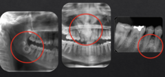 <p>How are these lesions described in terms of internal structure?</p>