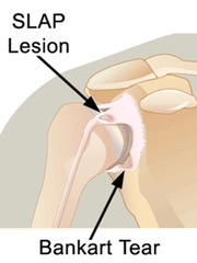 <p>Inferior labrum tear associated with shoulder dislocation.</p>