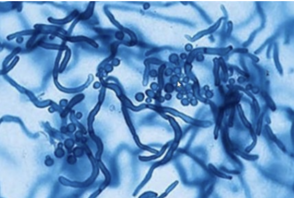 <p>-Causes tinea versicolor</p><p>-Requires lipid source (sterile olive oil)</p><p>-Yeast with “spaghetti and meatballs” morphology</p>